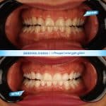 نمونه کار اصلاح لبخند در شیراز