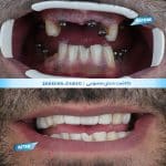 نمونه کار کاشت دندان مصنوعی در شیراز