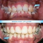 نمونه کار ارتودنسی دندان کلینیک زندیه