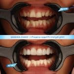 نمونه کار اصلاح لبخند در شیراز