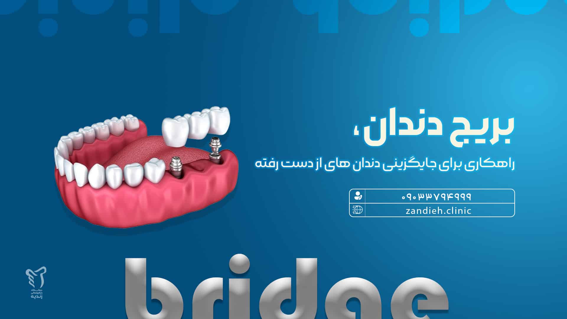 بریج دندان در شیراز