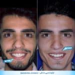نمونه کار ارتودنسی دندان کلینیک زندیه