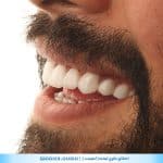 نمونه کار اصلاح لبخند در شیراز