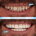 روکش دندان کلینیک زندیه