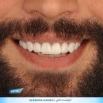 نمونه کار لمینت کشویی دندان در شیراز