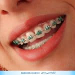 نمونه کار ارتودنسی دندان کلینیک زندیه