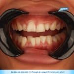 نمونه کار اصلاح لبخند در شیراز
