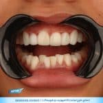 نمونه کار اصلاح لبخند در شیراز