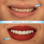 نمونه کار کامپوزیت دندان کلینیک زندیه