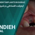 ایمپلنت اقساطی در شیراز