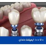همه چیز از ایمپلنت دندان (بایدها و نبایدها)