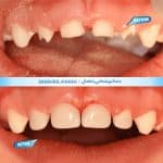 نمونه کار دندانپزشکی اطفال در شیراز