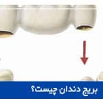 بریج دندان چیست؟
