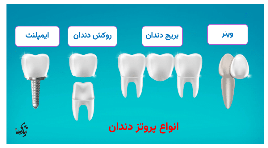 انواع پروتز دندان