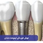 جوش خوردگی ایمپلنت دندان