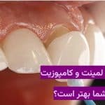 تفاوتهای لمینت و کامپوزیت|کدام برای شما بهتر است؟