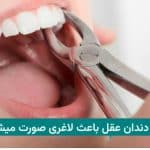 ایا کشیدن دندان عقل باعث لاغری صورت میشود؟ (همراه با نظر پزشکان)