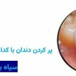پر کردن دندان با کدام مواد بهتر است؟ سیاه یا سفید
