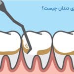 جرم گیری دندان چیست؟