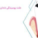 علت پوسیدگی دندان چیست؟