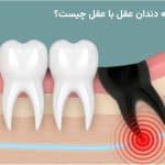 رابطه دندان عقل با عقل چیست؟