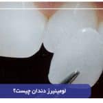 لومینیرز دندان چیست؟