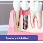 ایمپلنت کره ای یا سوئیسی؟