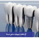 آیا کاشت ایمپلنت دائمی است؟