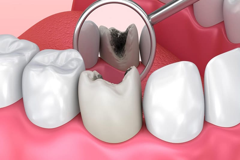 اهمیت تغذیه در سلامت دندان
