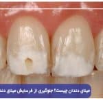 مینای دندان چیست؟ جلوگیری از فرسایش مینای دندان