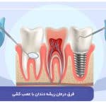 فرق درمان ریشه دندان با عصب کشی