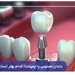 دندان مصنوعی یا ایمپلنت؟ کدام بهتر است؟