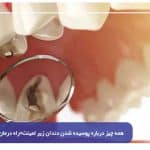 همه چیز درباره پوسیده شدن دندان زیر لمینت+راه درمان
