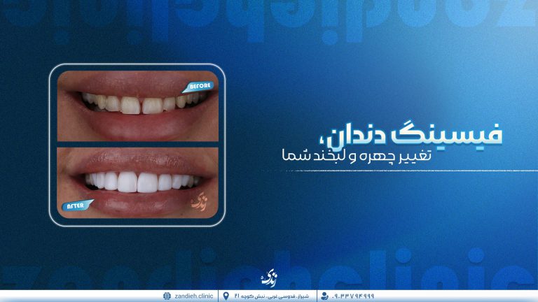 خدمات فیسینگ دندان در شیراز