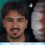 کامپوزیت دندان