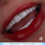 کامپوزیت دندان