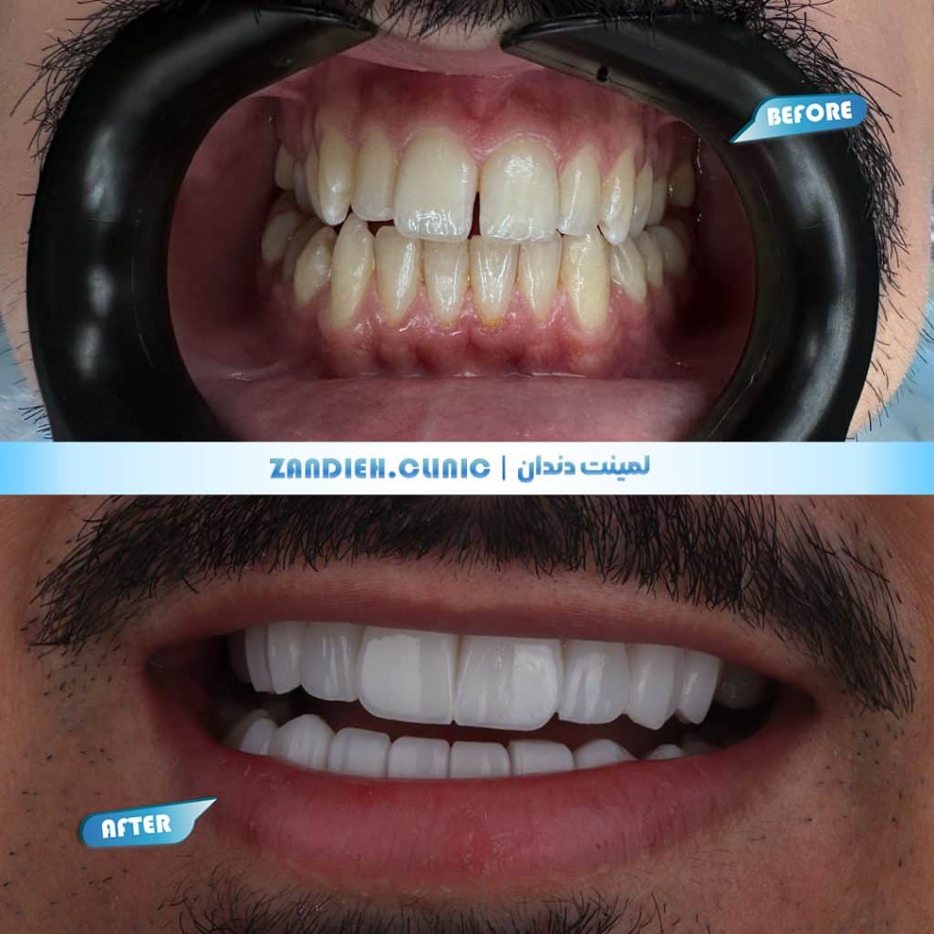 نمونه کار لمینت کلینیک زندیه در شیراز