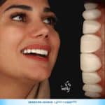 کامپوزیت دندان