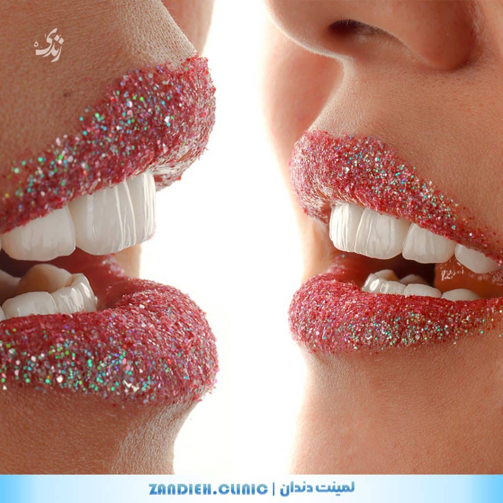 بهترین نتایج لمینت دندان در شیراز برای لبخند هالیوودی| اجرا شده توسط کلینیک زندیه قدوسی غربی شیراز