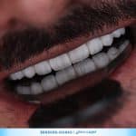 لمینت دندان