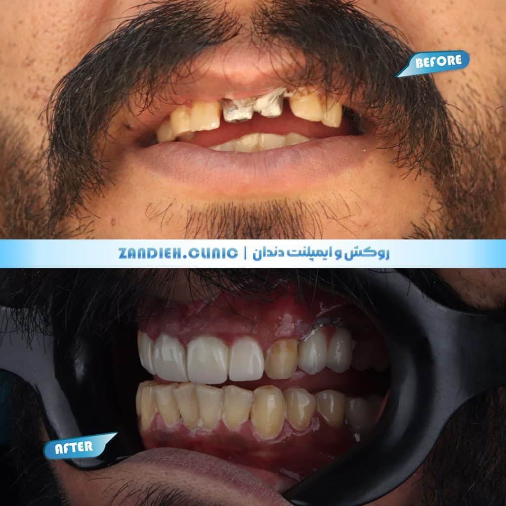 بهترین نتایج روکش دندان توسط دندانپزشک متخصص در زندیه شیراز