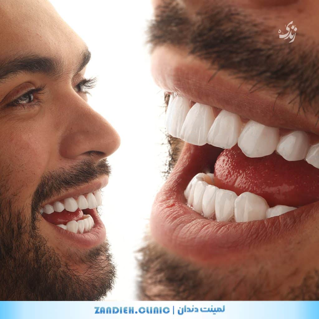 طراحی لبخند با لمینت دندان در شیراز