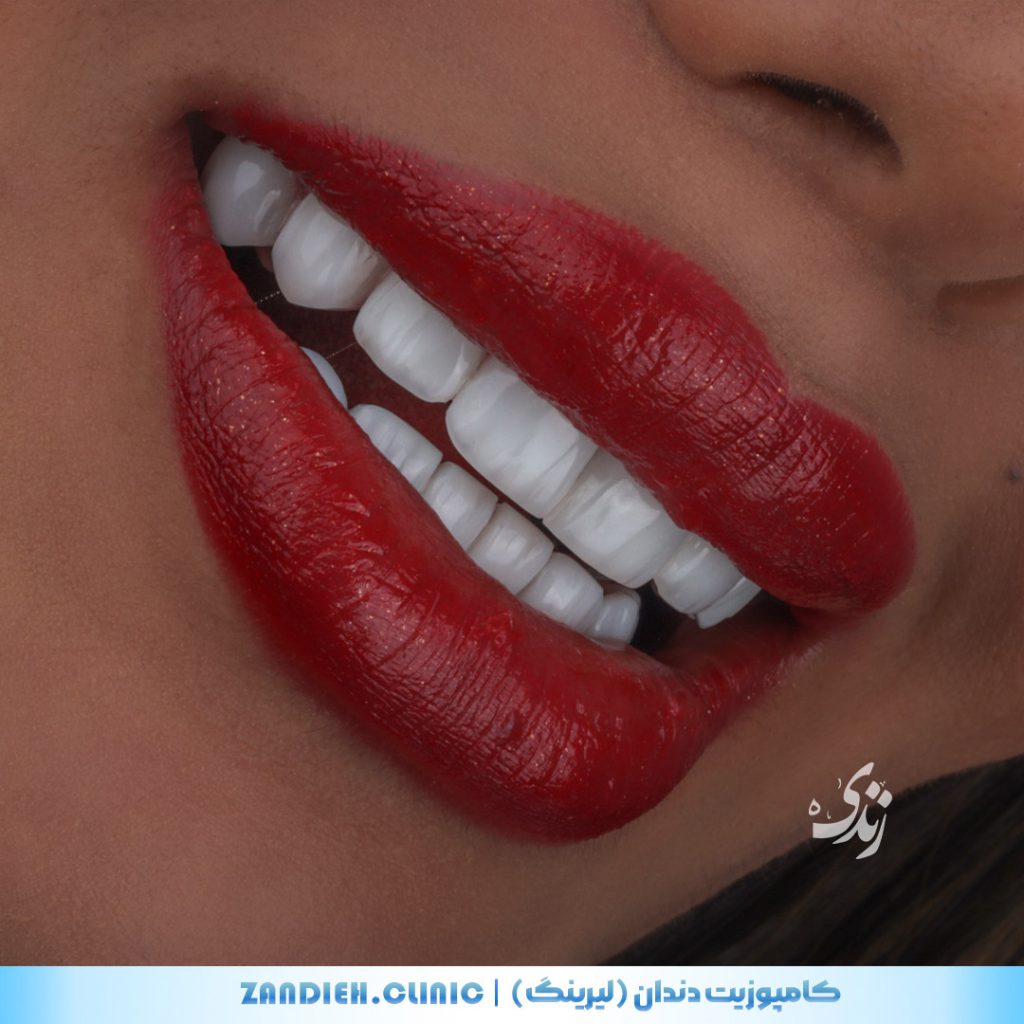 بهترین نتایج کامپوزیت دندان در شیراز توسط دندانپزشک متخصص