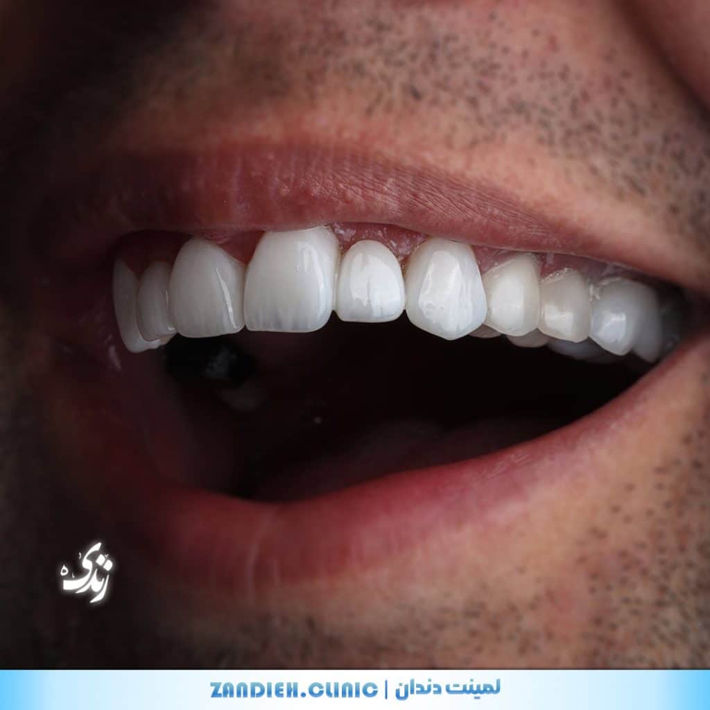 نمونه کار واقعی لمینت دندان در کلینیک زندیه شیراز