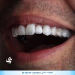 لمینت دندان