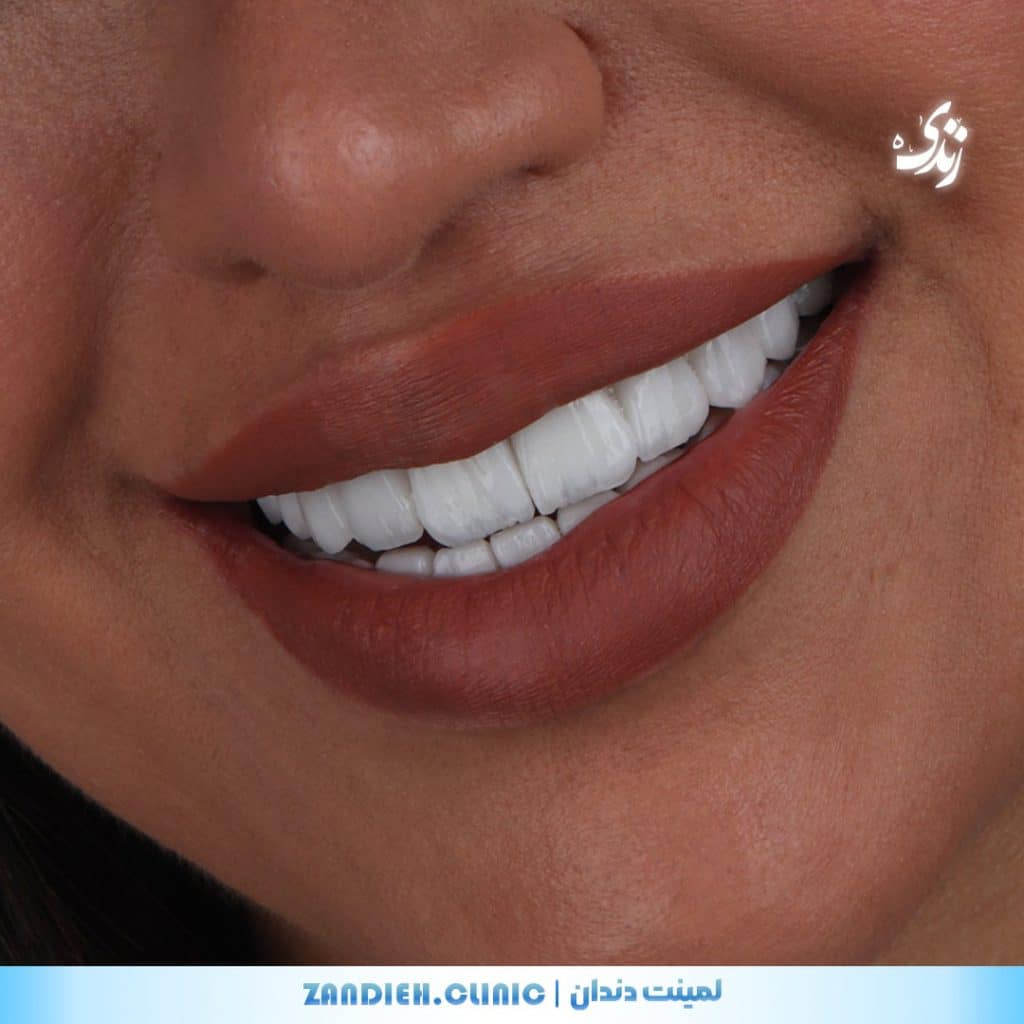 بهترین نتایج لمینت دندان در شیراز برای لبخند هالیوودی