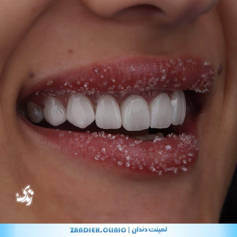 لمینت دندان جلو با ظاهری طبیعی در کلینیک زندیه