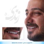نمونه کار کامپوزیت دندان کلینیک زندیه شیراز