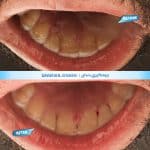 نمونه کار جرمگیری کلینیک زندیه شیراز