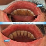 نمونه کار جرمگیری کلینیک زندیه شیراز